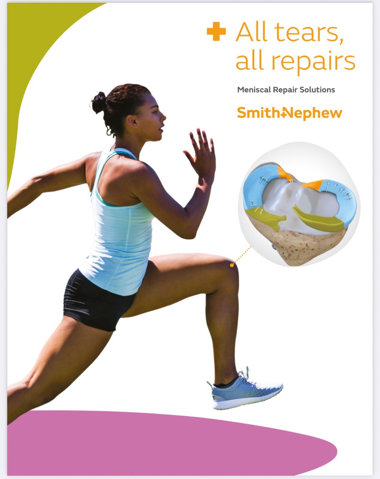 S&N All-Inside Meniscal Repair Solutions (Fast-Fix, NOVOSTITCH or Others…) 1Pcs